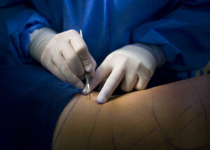 BODY PROCEDURES